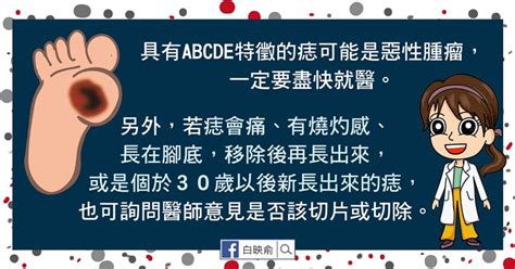 有問題的痣|我的「痣」會是惡性腫瘤嗎？醫師告訴你：符合這5特。